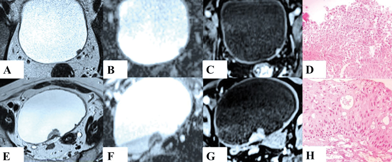 Application of Vesical Imaging-Reporting and Data System in Evaluation of Urinary Bladder Cancer Using Multiparametric Magnetic Resonance Imaging: A Hospital-Based Cross-Sectional Study.