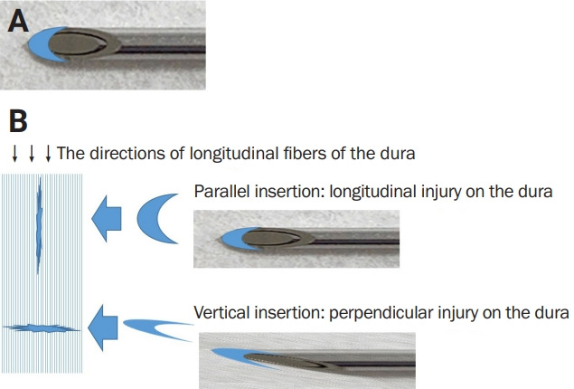 Lumbar puncture: considerations, procedure, and complications.