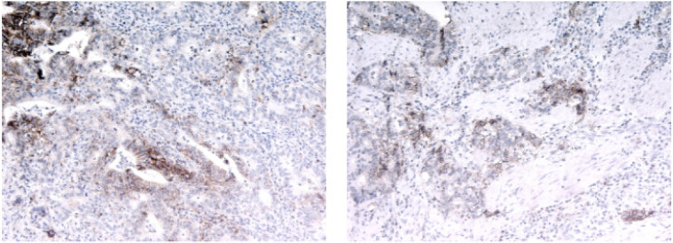 Comprehensive Analysis of Stromal and Serum Markers in Gastric Cancer.