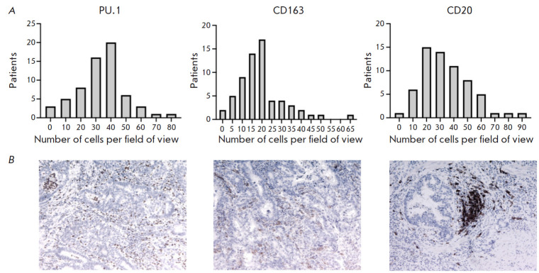 Comprehensive Analysis of Stromal and Serum Markers in Gastric Cancer.