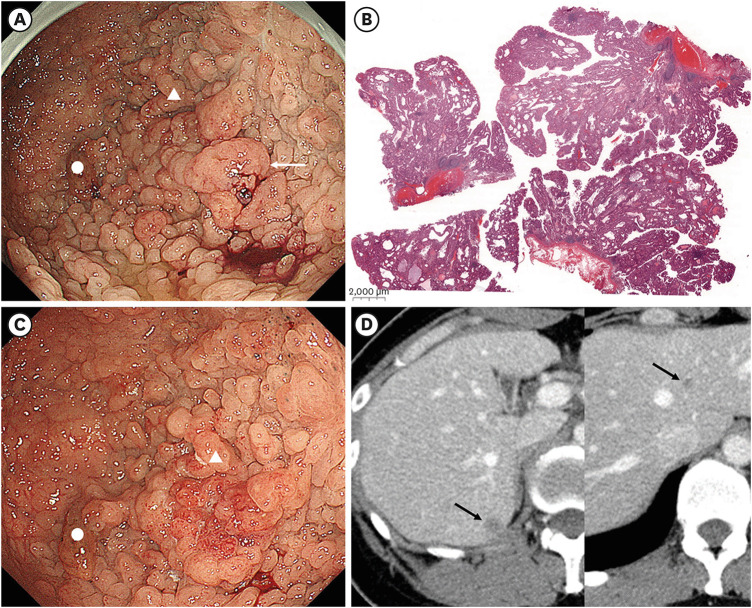 Endoscopic Findings and Treatment of Gastric Neoplasms in Familial Adenomatous Polyposis.