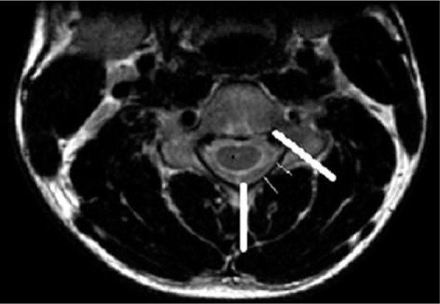 Hirayama disease: neutral and flexion magnetic resonance imaging and utility of inter-segmental angle of flexion.