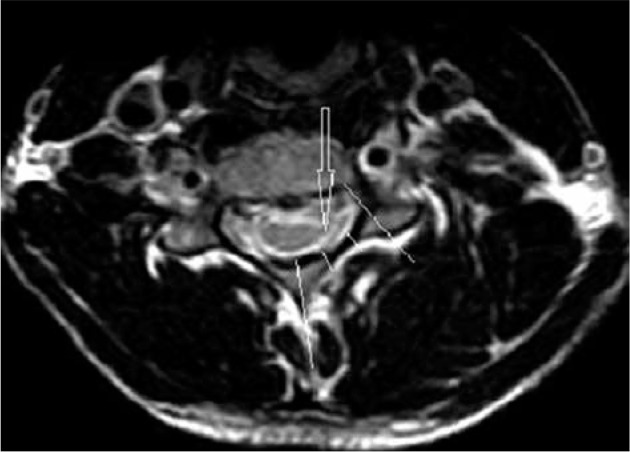 Hirayama disease: neutral and flexion magnetic resonance imaging and utility of inter-segmental angle of flexion.