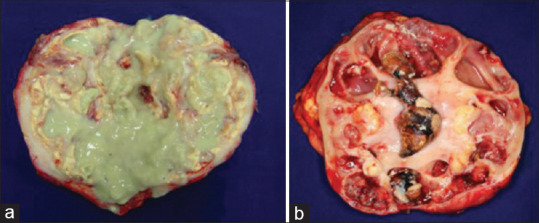 Xanthogranulomatous pyelonephritis: Case series - Clinical, radiologic, therapeutic, and histological aspects.