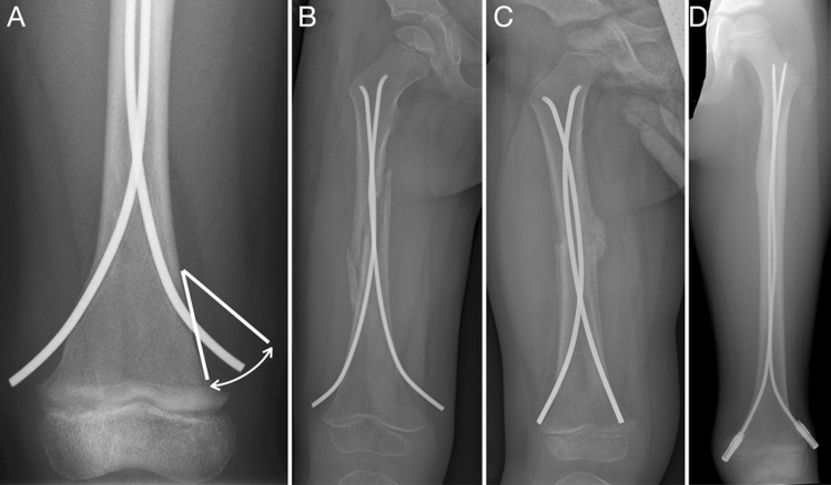 Implant removal associated complications after ESIN osteosynthesis in pediatric fractures.