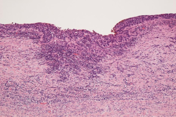 Extraregional lymph node recurrence of stage IA1 squamous cell carcinoma of the uterine cervix after initial surgery: two case studies.