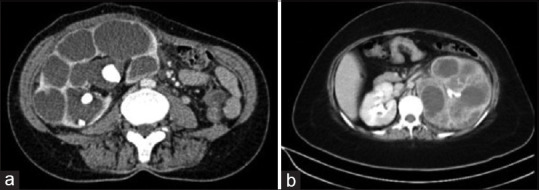 Xanthogranulomatous pyelonephritis: Case series - Clinical, radiologic, therapeutic, and histological aspects.