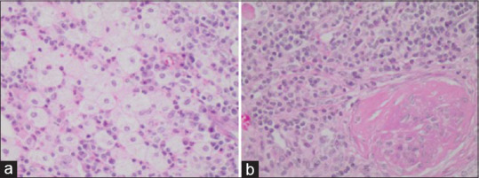 Xanthogranulomatous pyelonephritis: Case series - Clinical, radiologic, therapeutic, and histological aspects.