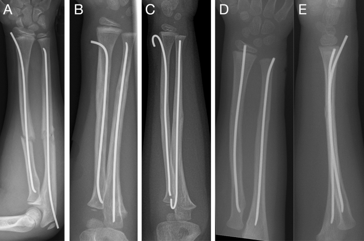 Implant removal associated complications after ESIN osteosynthesis in pediatric fractures.