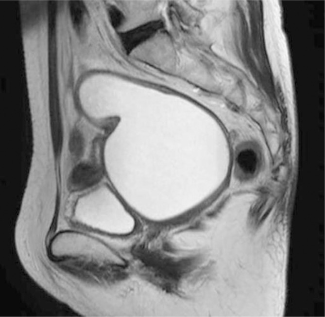 Extraregional lymph node recurrence of stage IA1 squamous cell carcinoma of the uterine cervix after initial surgery: two case studies.