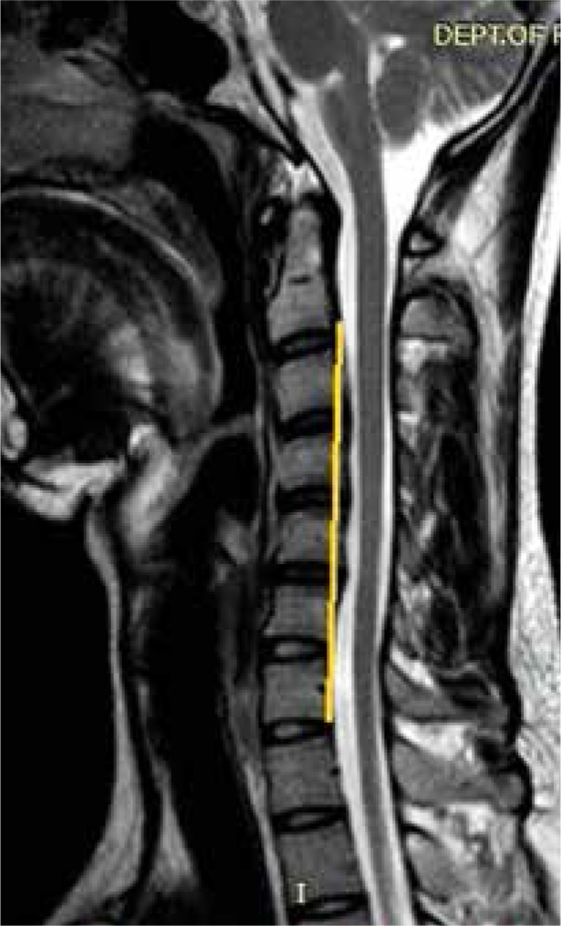 Hirayama disease: neutral and flexion magnetic resonance imaging and utility of inter-segmental angle of flexion.