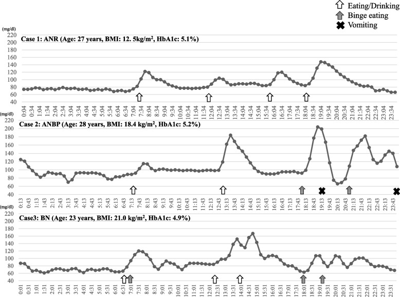 Continuous glucose monitoring for detection of glycemic variability, hypoglycemia, and hyperglycemia in women with eating disorders.