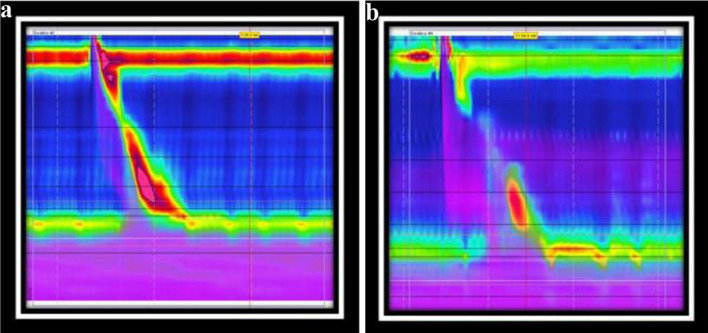 The Supportive Role of Provocative Maneuvers and Impedance Clearance in Detecting Ineffective Esophageal Motility.