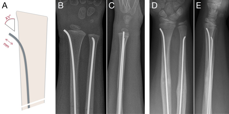 Implant removal associated complications after ESIN osteosynthesis in pediatric fractures.