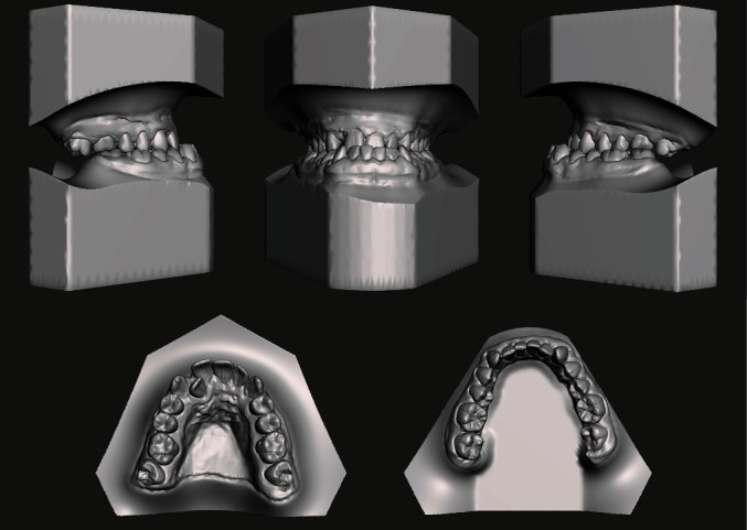 A Full Computerized Workflow for Planning Surgically Assisted Rapid Palatal Expansion and Orthognathic Surgery in a Skeletal Class III Patient.