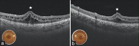 Posterior Microphthalmos Pigmentary Retinopathy Syndrome with Angle-Closure Glaucoma: A Case Report.