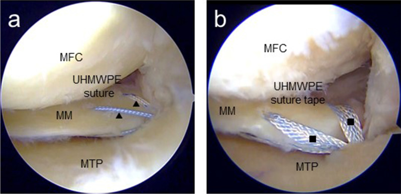 Clinical evaluation of suture materials for transtibial pullout repair of medial meniscus posterior root tear.