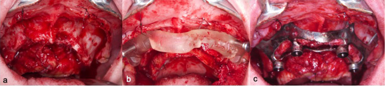 Adapting a simple surgical manual tool to a 3D printed implantology protocol: the use of a universal screwdriver for fixation of custom-made laser sintered titanium subperiosteal implants.