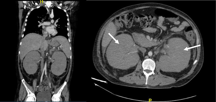 Isolated Renal Relapse in a Post-Allogenic Transplant Adult Patient With Acute Lymphoblastic Leukemia.