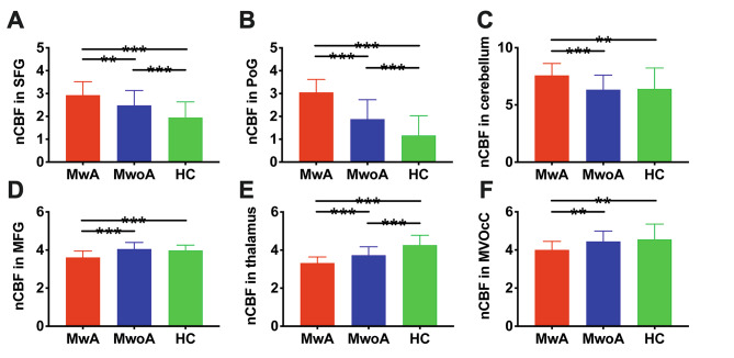 Cerebral blood flow alterations in migraine patients with and without aura: An arterial spin labeling study.