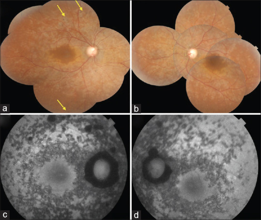 Posterior Microphthalmos Pigmentary Retinopathy Syndrome with Angle-Closure Glaucoma: A Case Report.