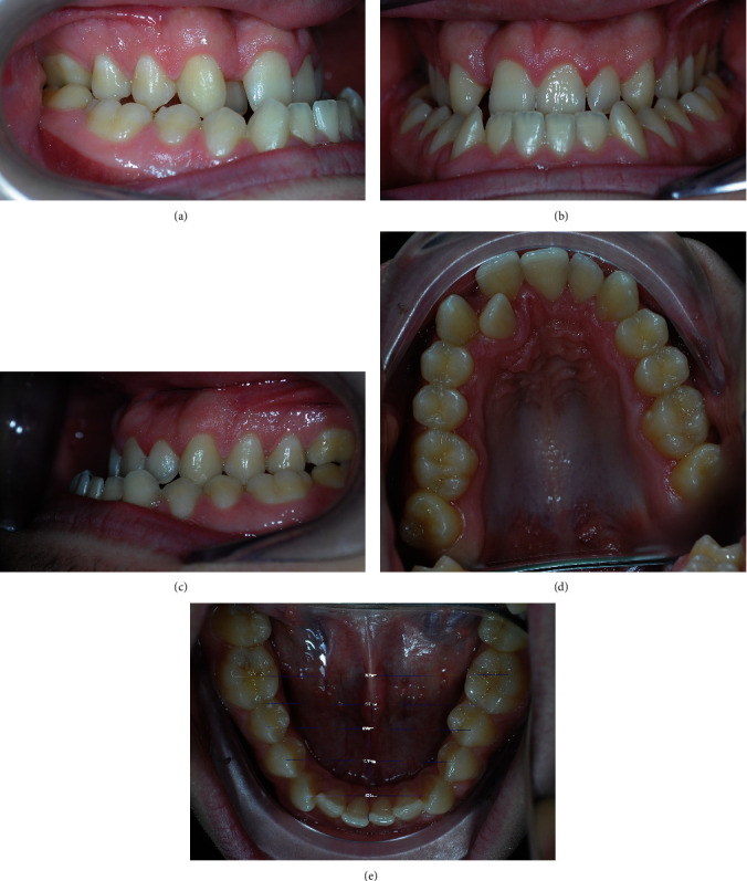 A Full Computerized Workflow for Planning Surgically Assisted Rapid Palatal Expansion and Orthognathic Surgery in a Skeletal Class III Patient.
