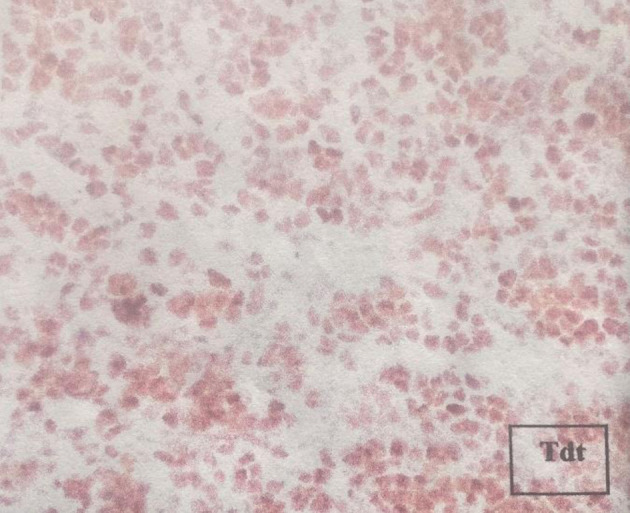 Isolated Renal Relapse in a Post-Allogenic Transplant Adult Patient With Acute Lymphoblastic Leukemia.