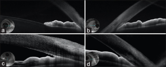 Posterior Microphthalmos Pigmentary Retinopathy Syndrome with Angle-Closure Glaucoma: A Case Report.