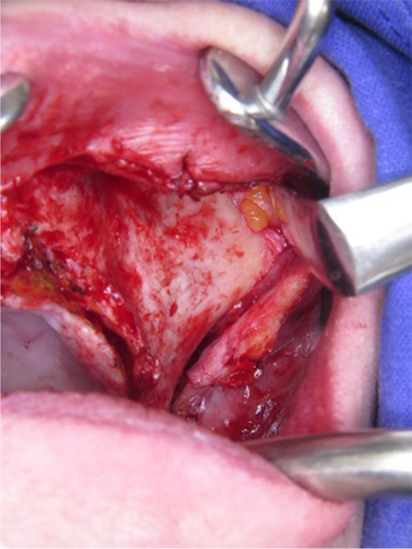 Adapting a simple surgical manual tool to a 3D printed implantology protocol: the use of a universal screwdriver for fixation of custom-made laser sintered titanium subperiosteal implants.