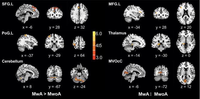 Cerebral blood flow alterations in migraine patients with and without aura: An arterial spin labeling study.