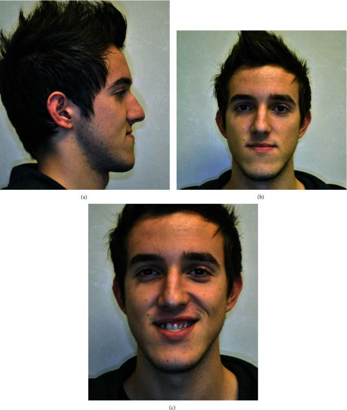 A Full Computerized Workflow for Planning Surgically Assisted Rapid Palatal Expansion and Orthognathic Surgery in a Skeletal Class III Patient.