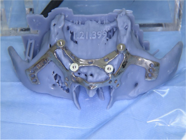 Adapting a simple surgical manual tool to a 3D printed implantology protocol: the use of a universal screwdriver for fixation of custom-made laser sintered titanium subperiosteal implants.