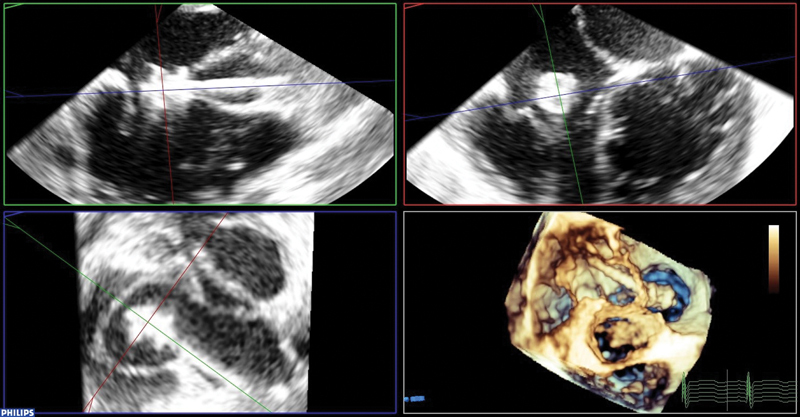 Interventional Closure of a Ruptured Sinus of Valsalva with a Konar-Multifunctional Device.