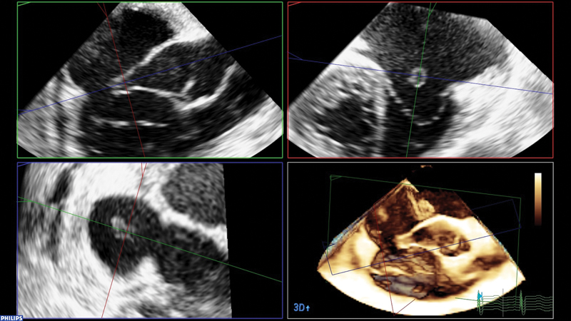 Interventional Closure of a Ruptured Sinus of Valsalva with a Konar-Multifunctional Device.