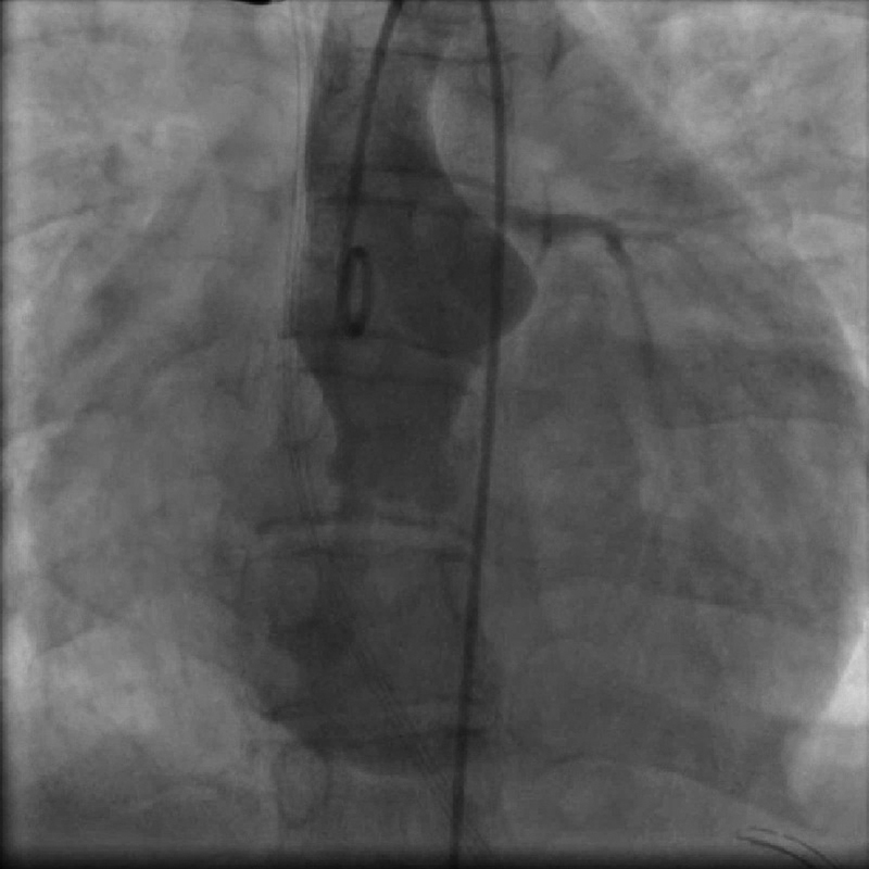 Interventional Closure of a Ruptured Sinus of Valsalva with a Konar-Multifunctional Device.