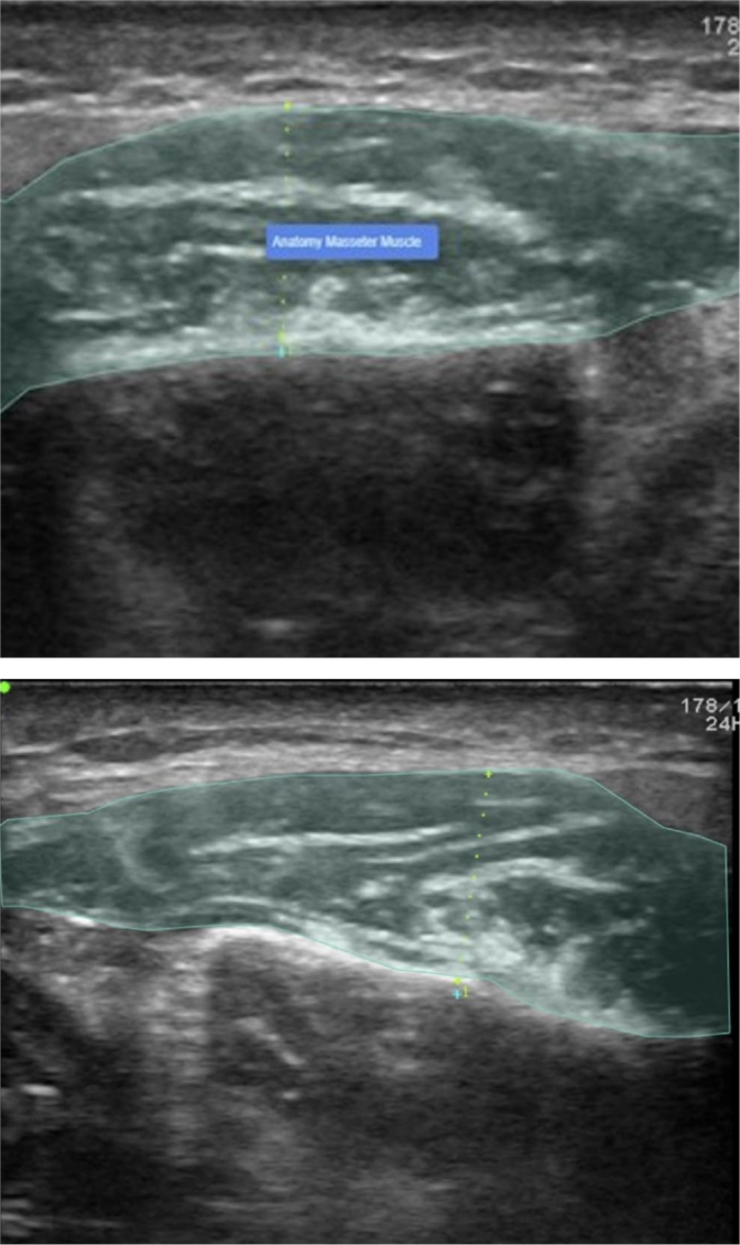 A Deep Learning Approach for Masseter Muscle Segmentation on Ultrasonography.