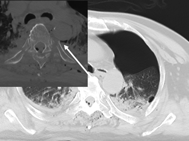 Penetrating Aortic Injury due to Broken Ribs and Preventive Measures.