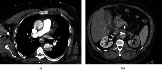 Acute Limb Ischemia Caused by Dissection following Percutaneous Coronary Intervention Using Right Radial Approach.