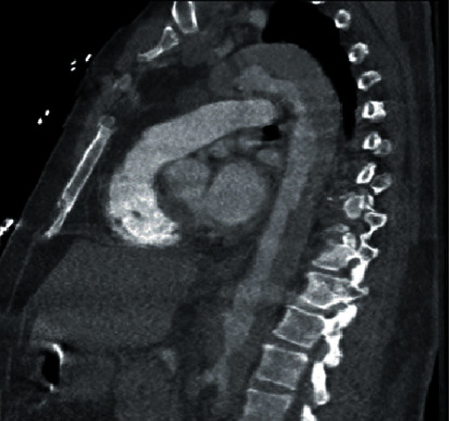 Acute Limb Ischemia Caused by Dissection following Percutaneous Coronary Intervention Using Right Radial Approach.