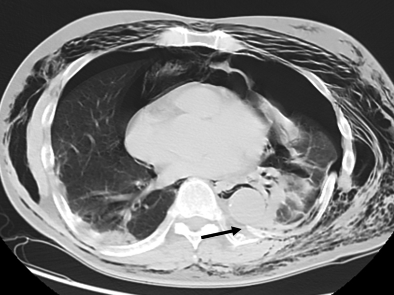 Penetrating Aortic Injury due to Broken Ribs and Preventive Measures.