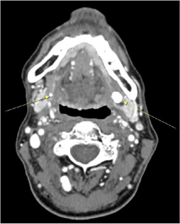 Therapeutic effects of sialendoscopy for diagnosis and treatment of hyposalivation patients: a retrospective study.