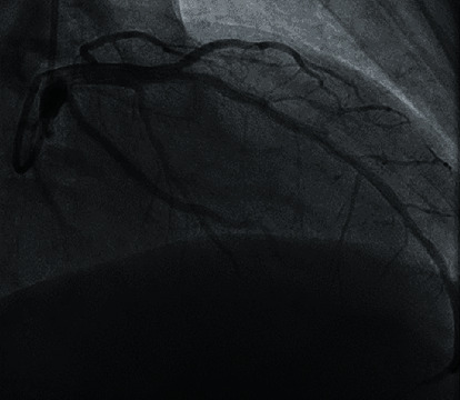 Acute Limb Ischemia Caused by Dissection following Percutaneous Coronary Intervention Using Right Radial Approach.