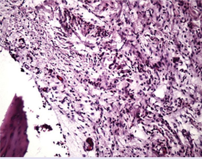 Rifaximine spacer application is not superior to local teicoplanin treatment in a rat model of osteomyelitis.