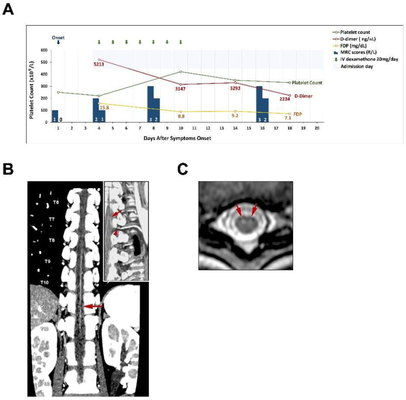 Postpartum Spinal Cord Infarction: A Case Report and Review of the Literature.