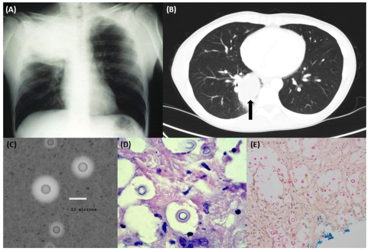 Pulmonary Cryptococcosis.