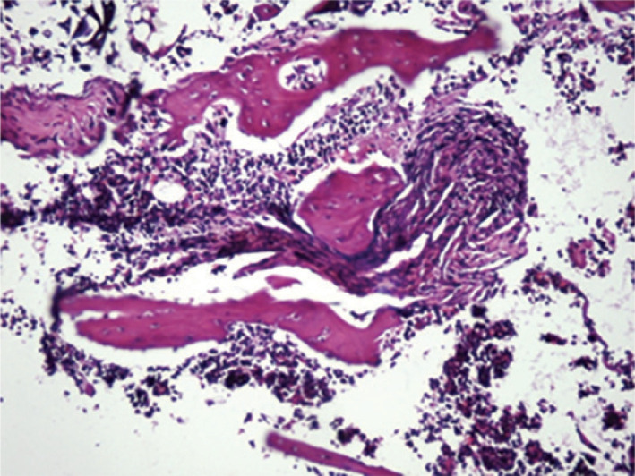 Rifaximine spacer application is not superior to local teicoplanin treatment in a rat model of osteomyelitis.