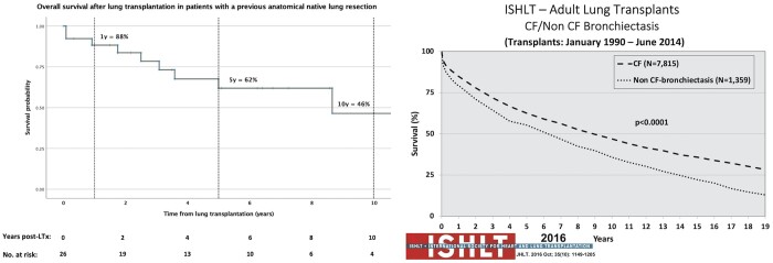 Lung transplantation in patients with a history of anatomical native lung resection.