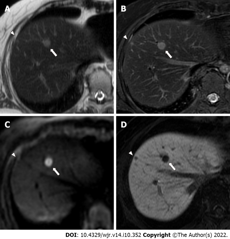 Diagnostic performance of abbreviated gadoxetic acid-enhanced magnetic resonance protocols with contrast-enhanced computed tomography for detection of colorectal liver metastases.