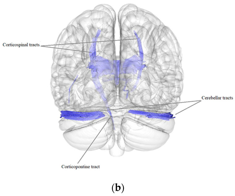 Microstructural Properties of Brain White Matter Tracts in Breast Cancer Survivors: A Diffusion Tensor Imaging Study.