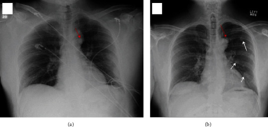 Calcification in Thoracic Splenosis.